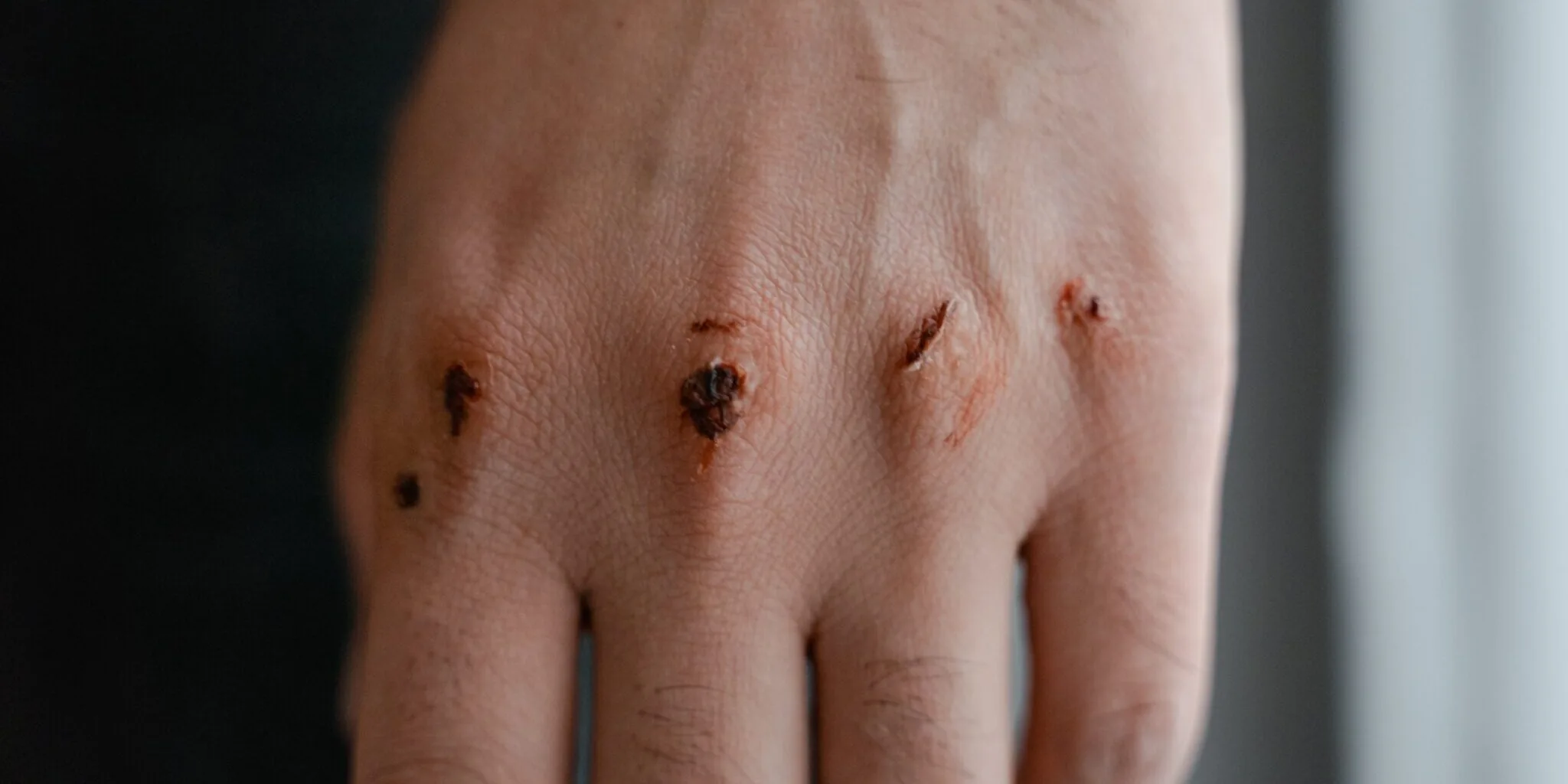Hand Injuries: Immediate Steps, Expert Care, and Recovery