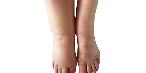 Lymphedema Precautions: Protecting Your Health and Quality of Life