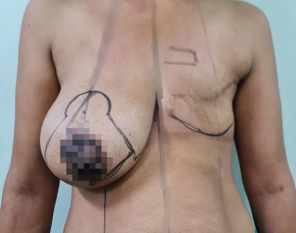 Breast Reconstruction — before