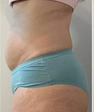 Before surgery