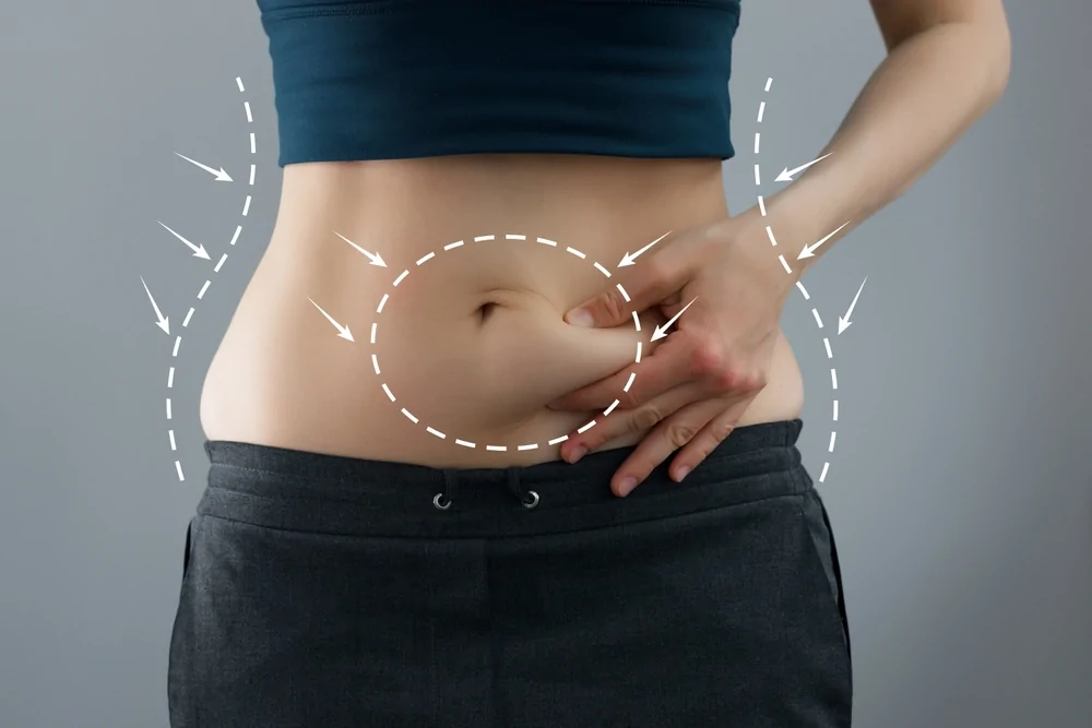 Lipoabdominoplasty — hero image