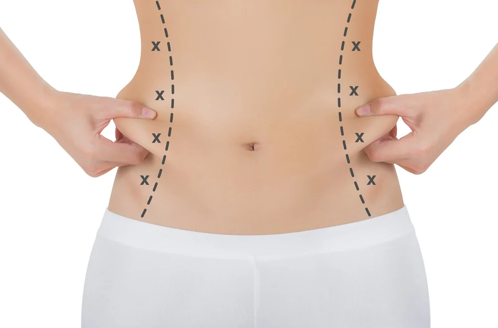 Liposuction — hero image