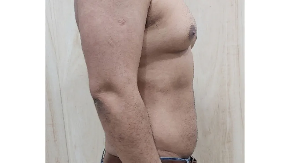 After surgery
