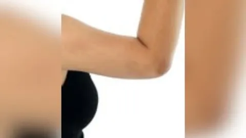 Arm Liposuction — after