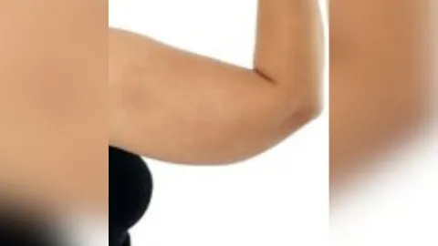 Arm Liposuction — before
