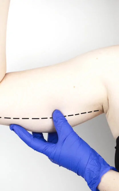 Brachioplasty