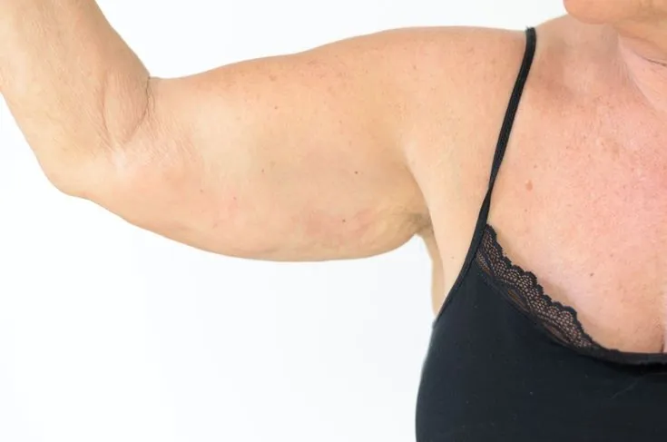 Brachioplasty Arm Lift — before
