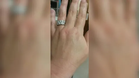 Fat Transfer To Hands — after