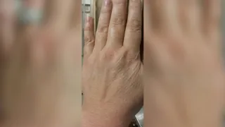 Fat Transfer To Hands — before