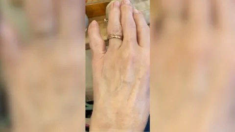 Fat Transfer To Hands — after