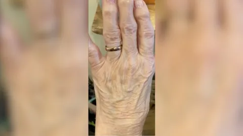 Fat Transfer To Hands — before