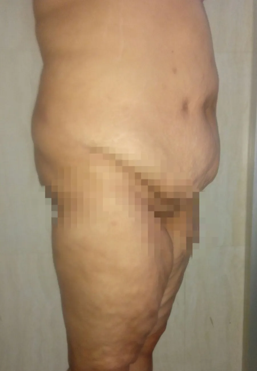Before surgery