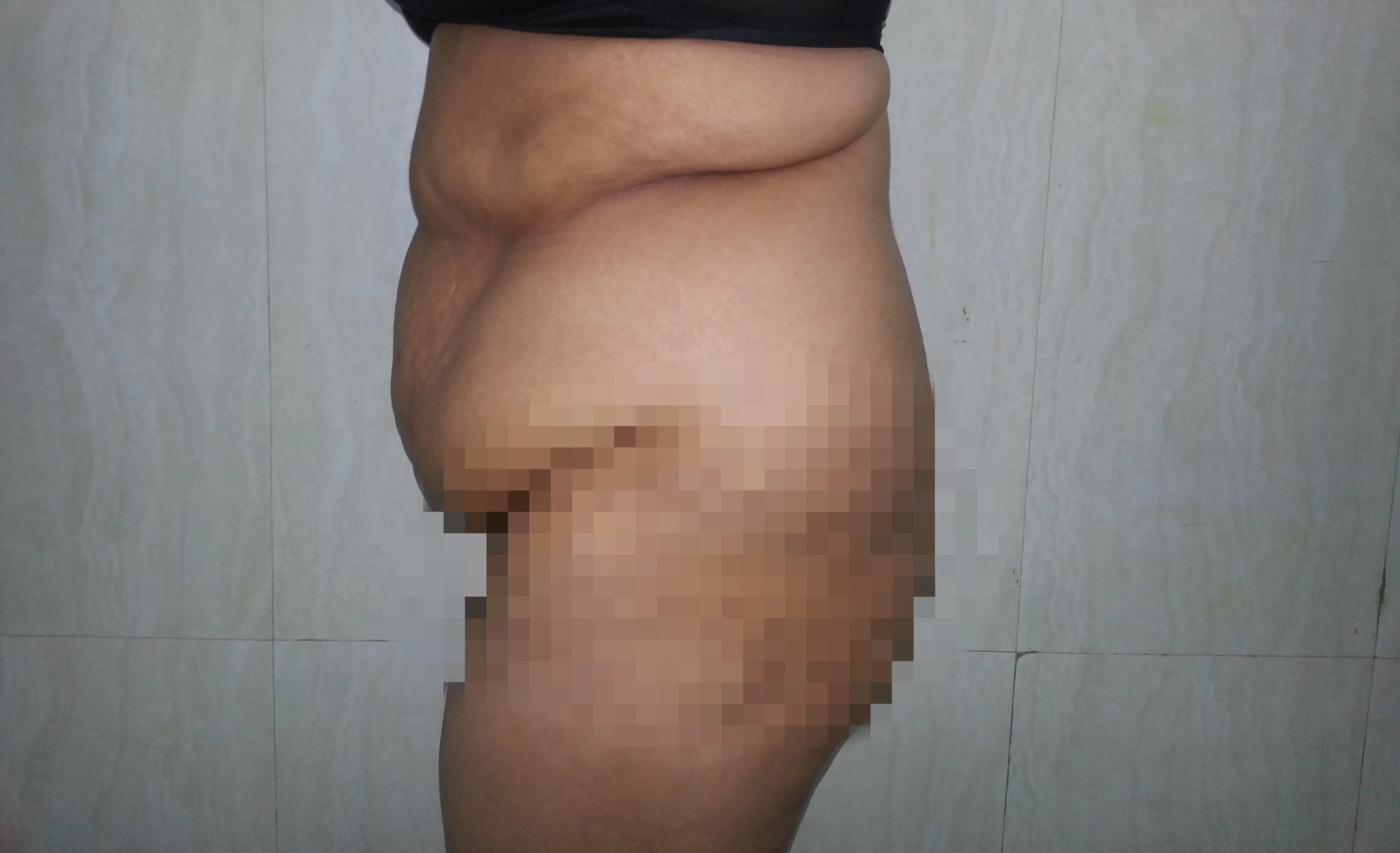 Before surgery