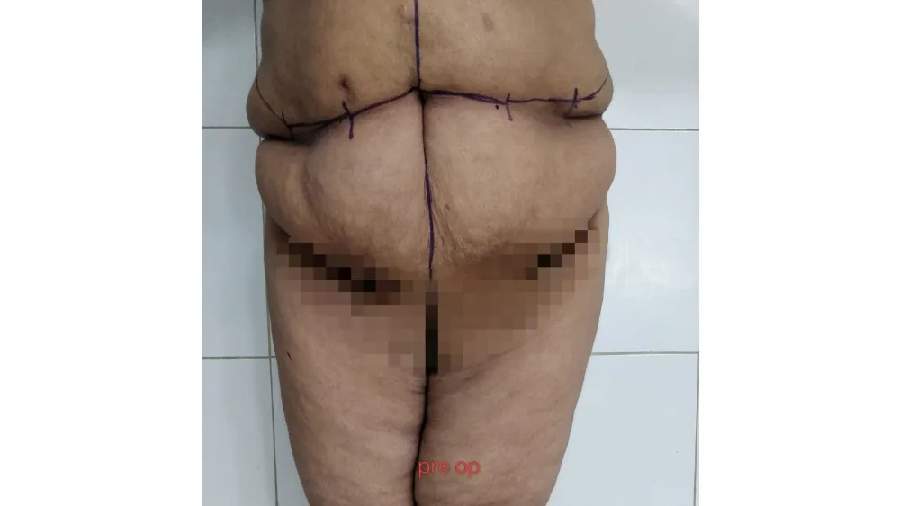 Before surgery