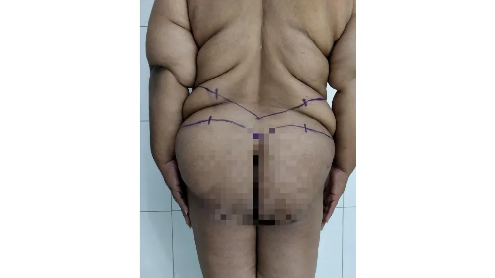 Before surgery