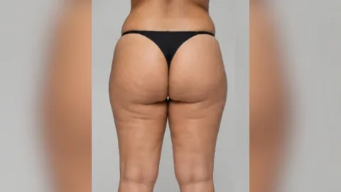 Buttocks Thighs Liposuction — before