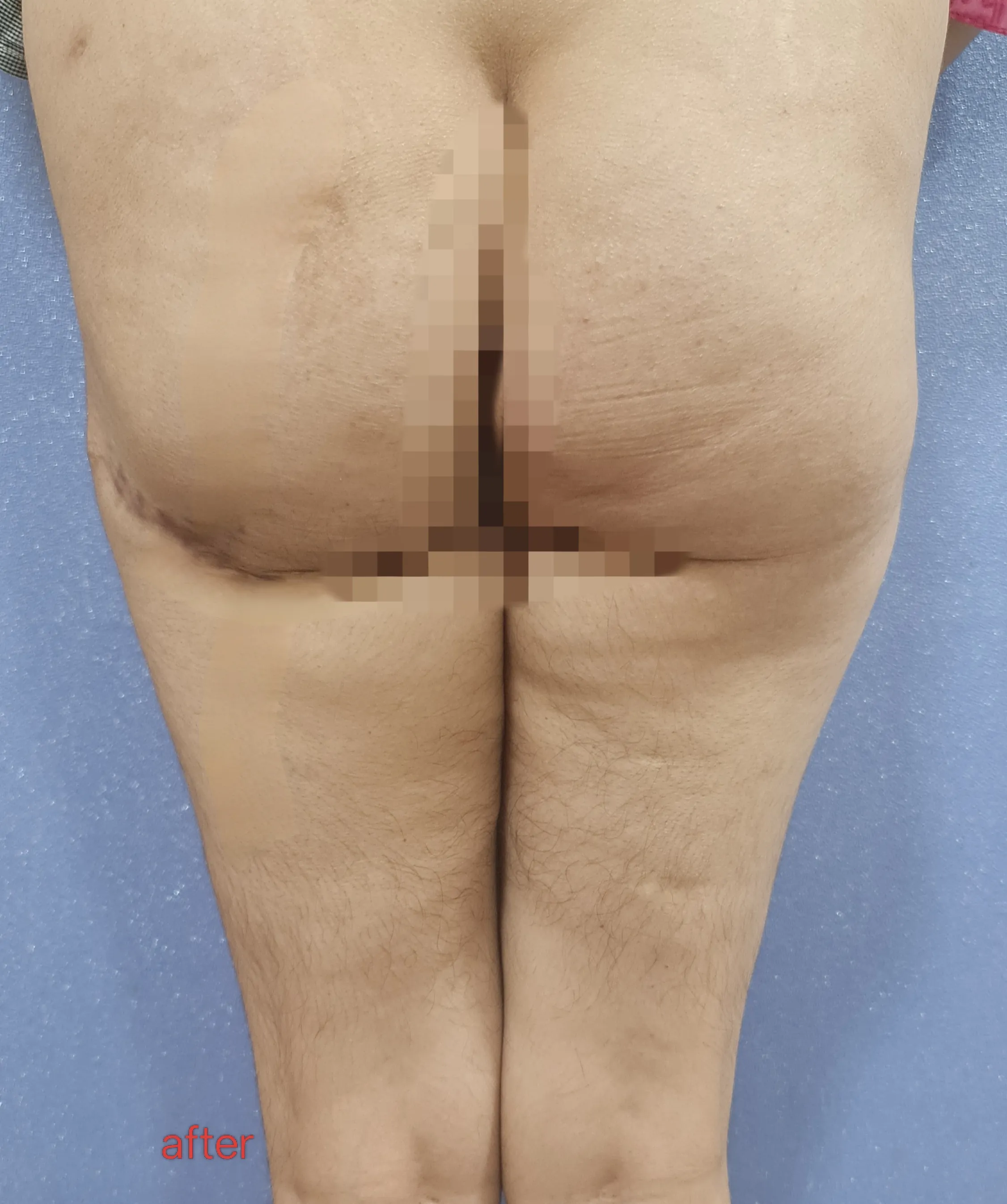 Buttocks Thighs Liposuction — after