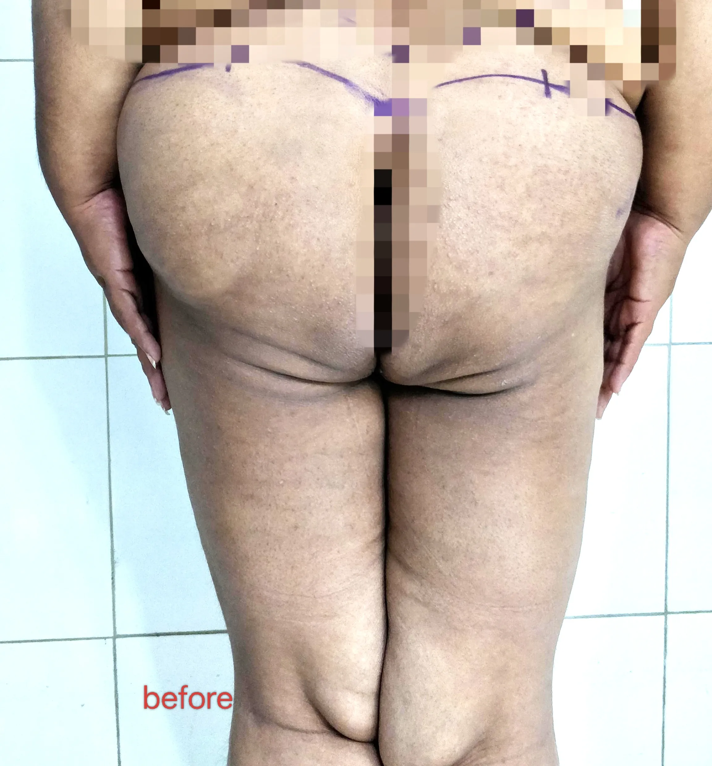 Buttocks Thighs Liposuction — before