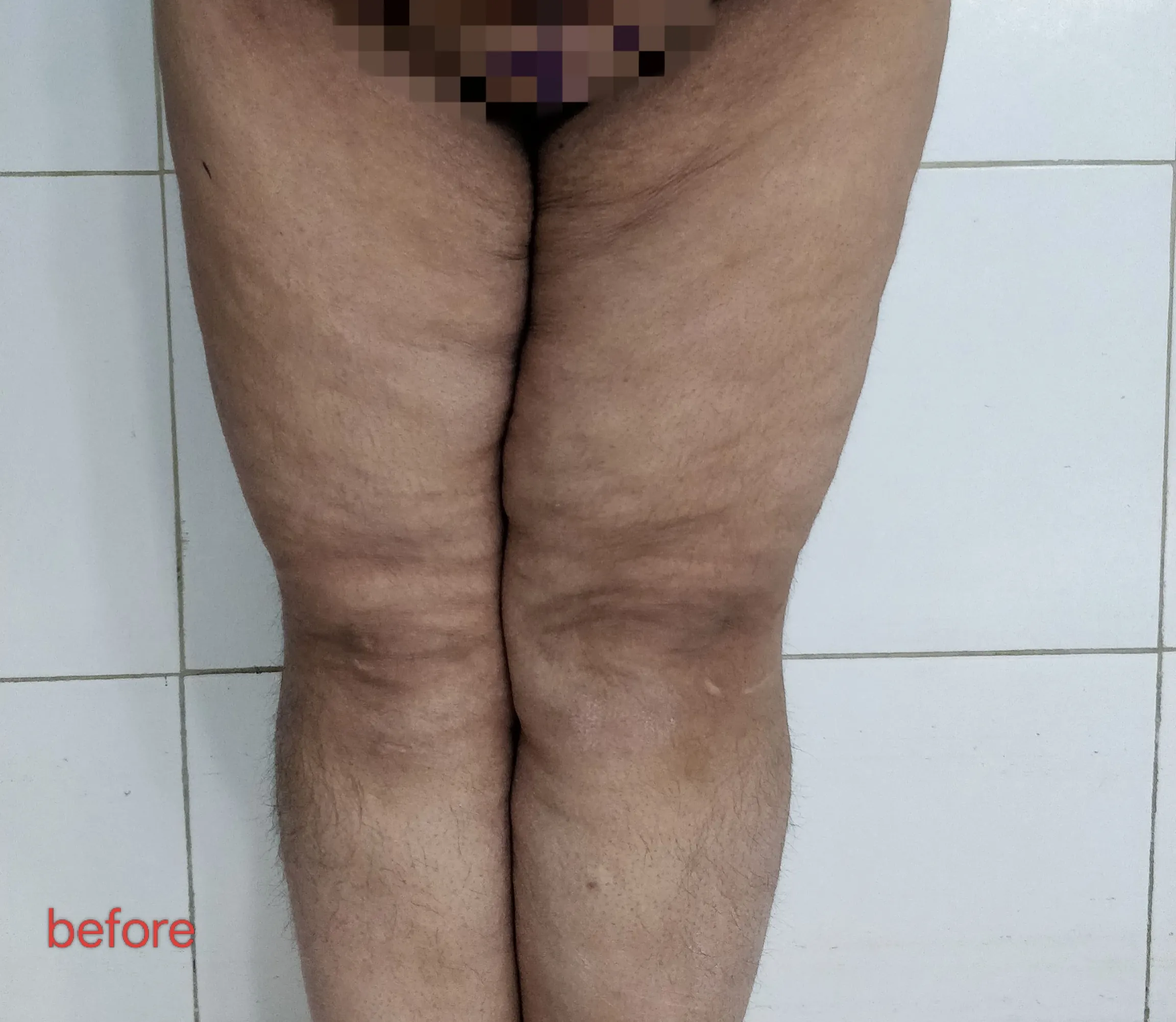 Buttocks Thighs Liposuction — before