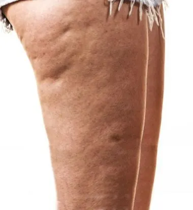 Medial Thigh Lift — before