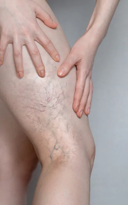 Spider Vein Treatment