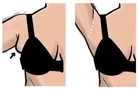 Axillary Breast — procedure visual