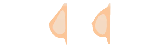 Breast Augmentation