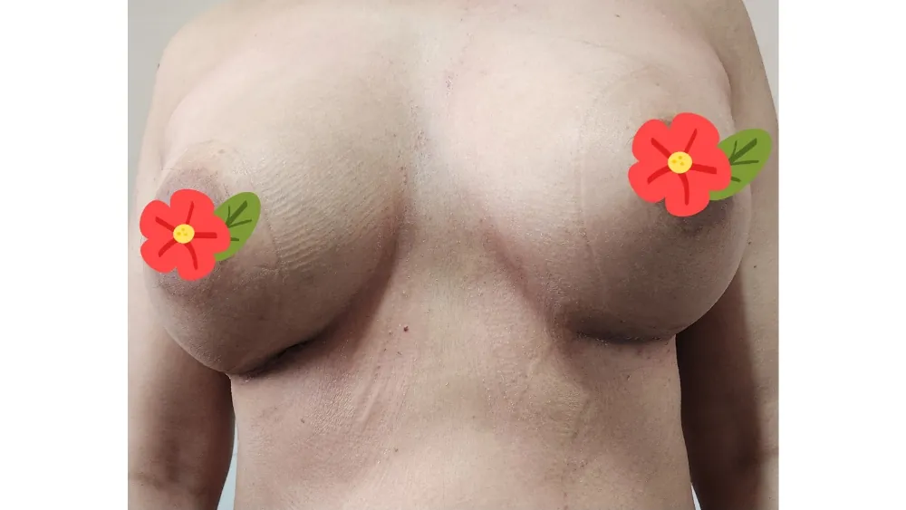 After surgery