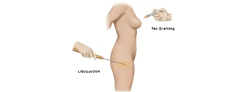 Breast Augmentation