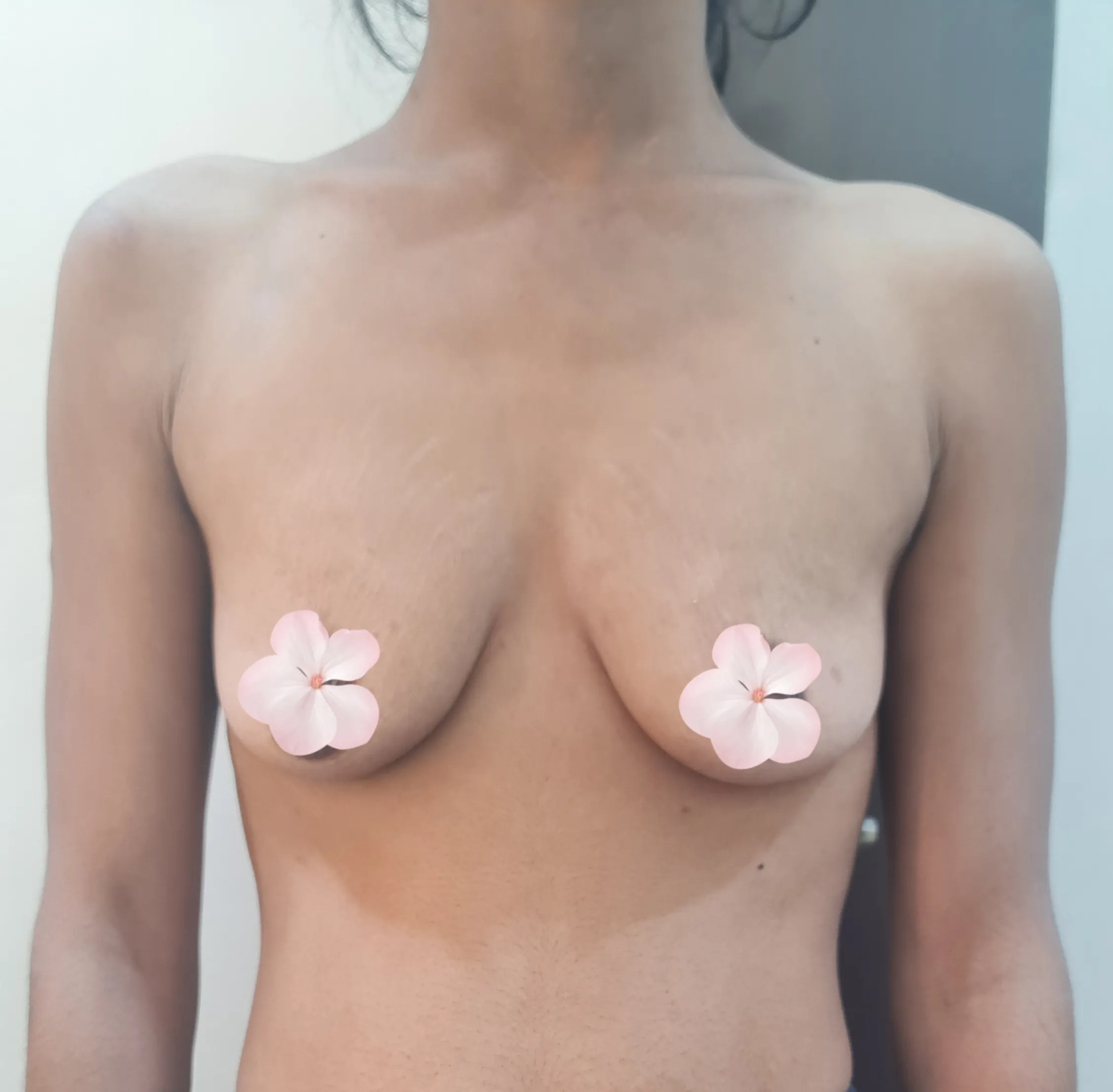 Breast Lift — before