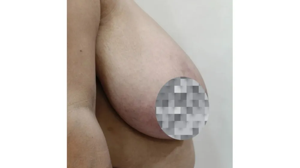 Breast Reduction — before