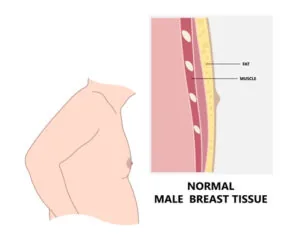 Gynecomastia