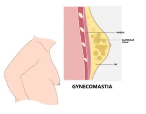 Gynecomastia