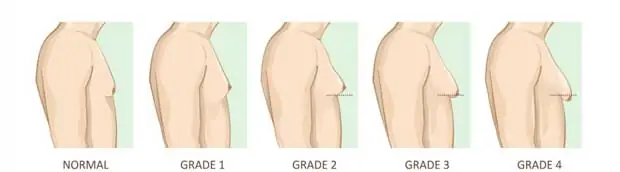 Gynecomastia