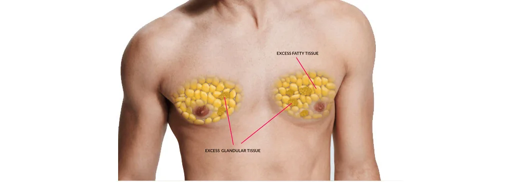 Gynecomastia
