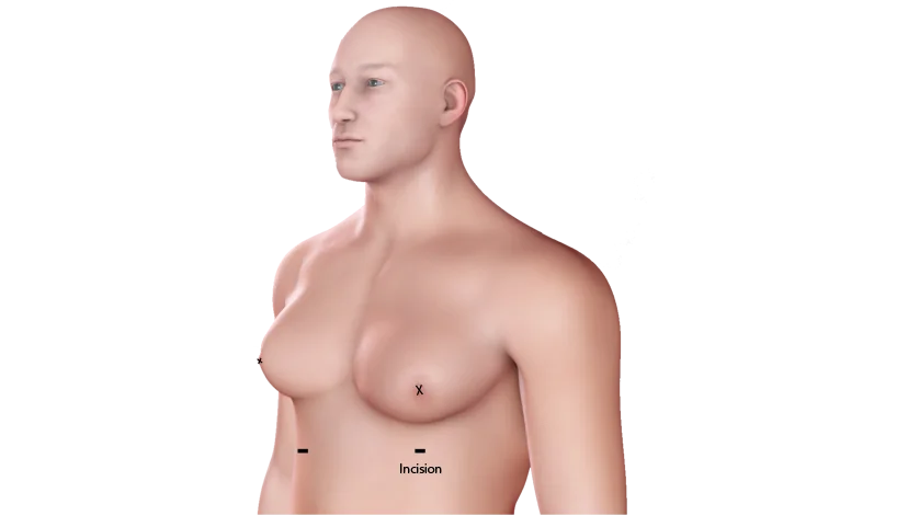 Gynecomastia