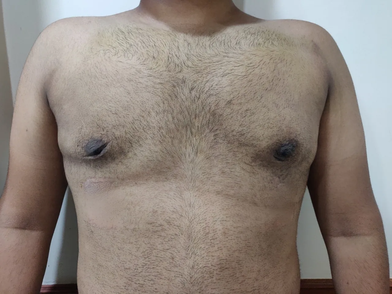 Gynecomastia — after