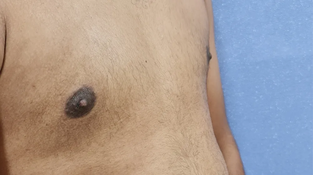 Gynecomastia — after