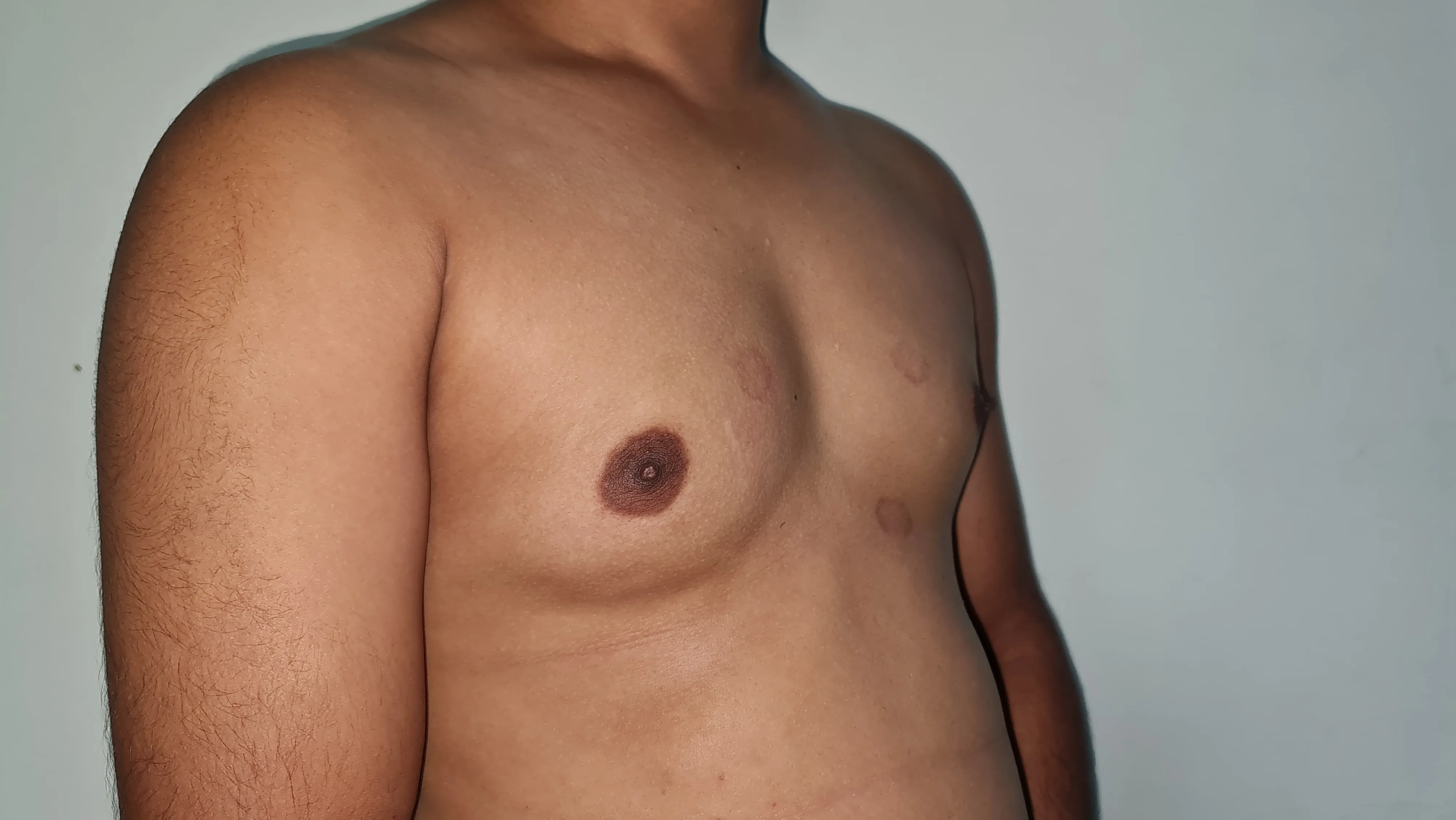 Gynecomastia — before