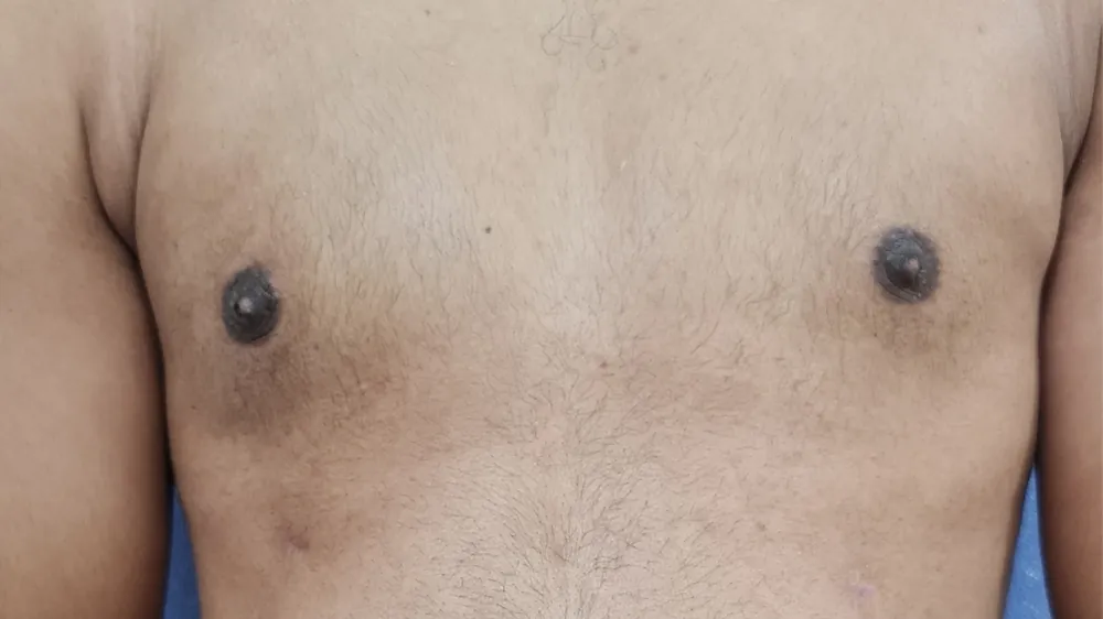 Gynecomastia — after