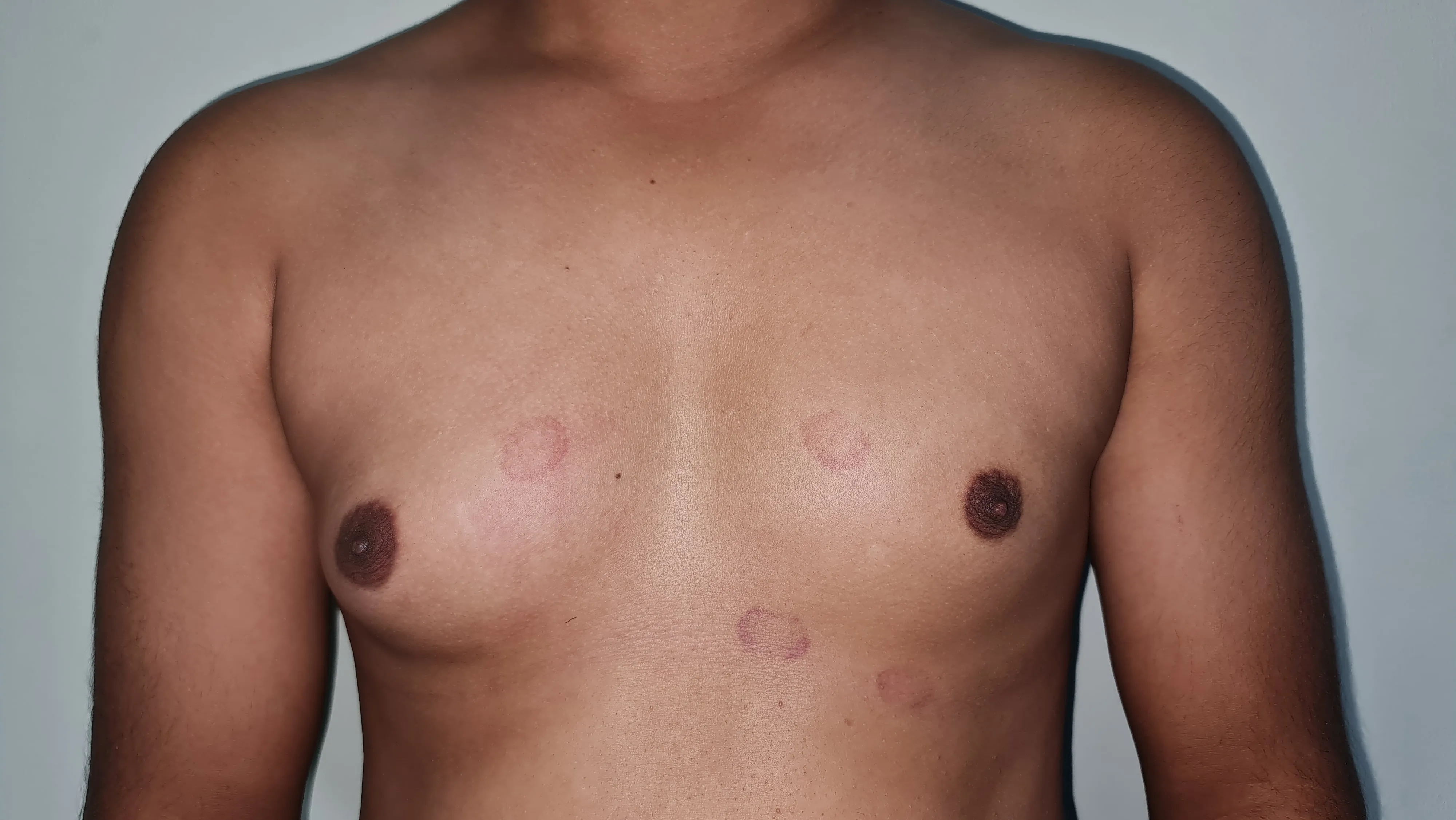 Gynecomastia — before