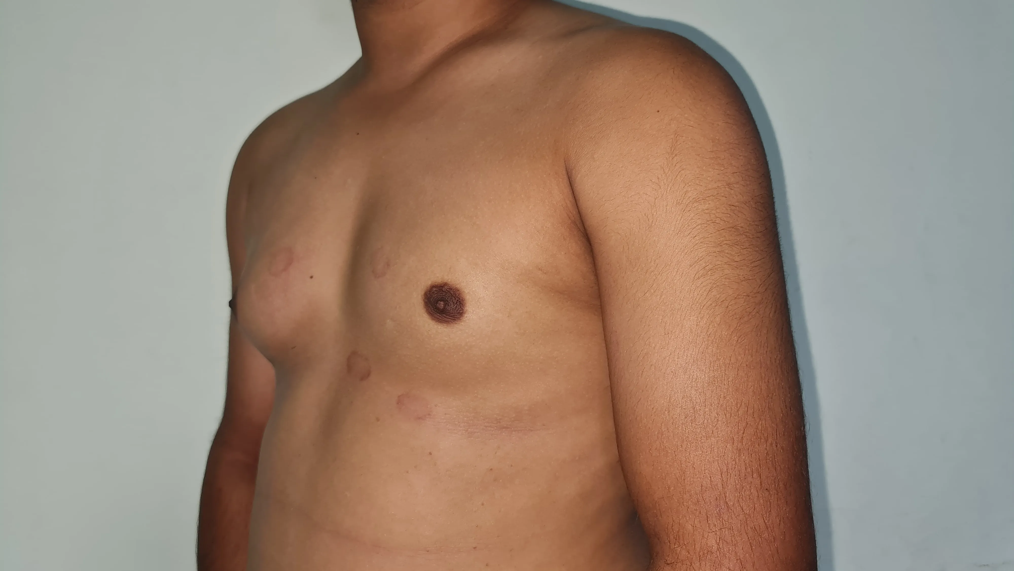 Gynecomastia — before