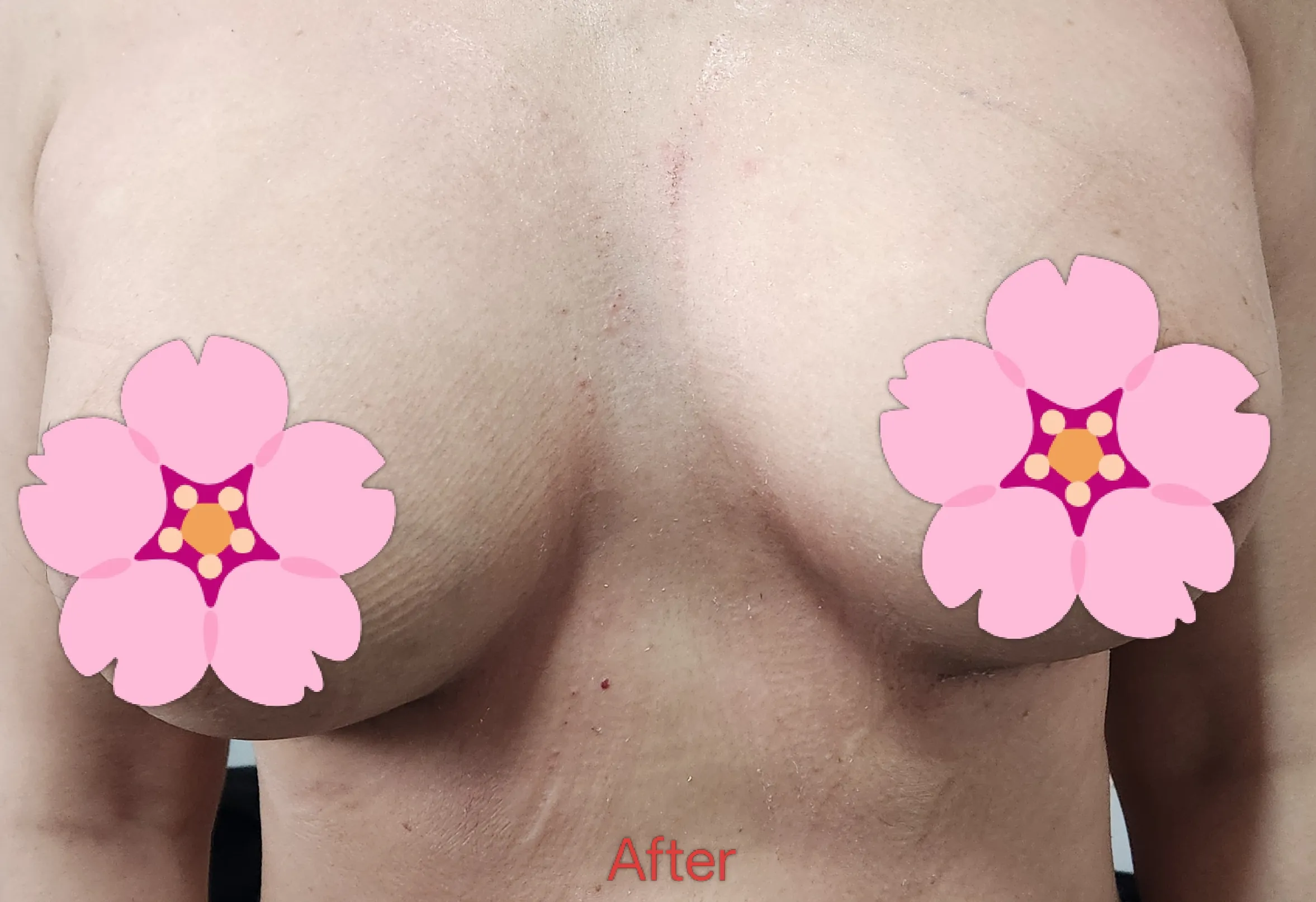 After surgery