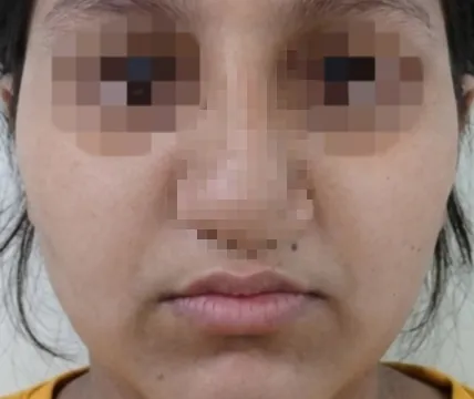 Buccal Fat Removal — after