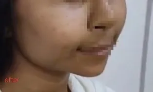 After surgery