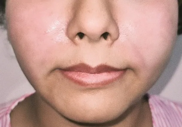 After surgery