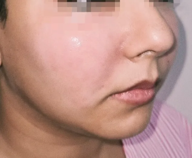 After surgery
