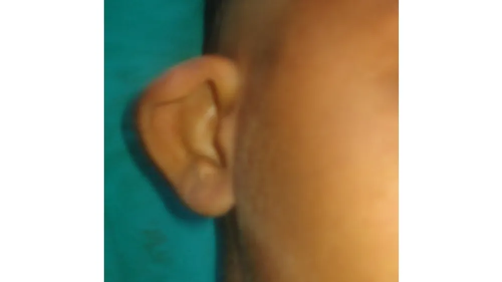Before surgery
