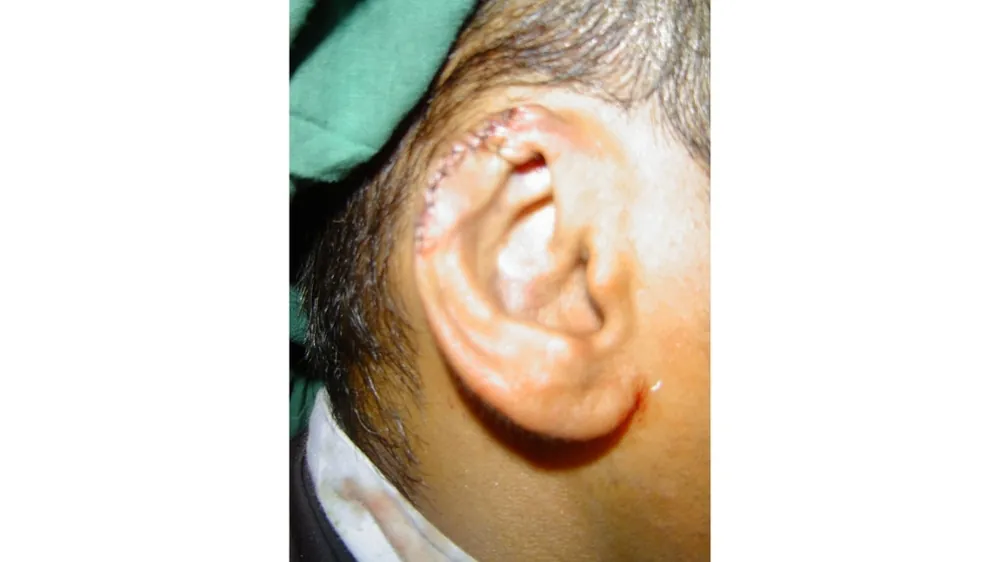 After surgery