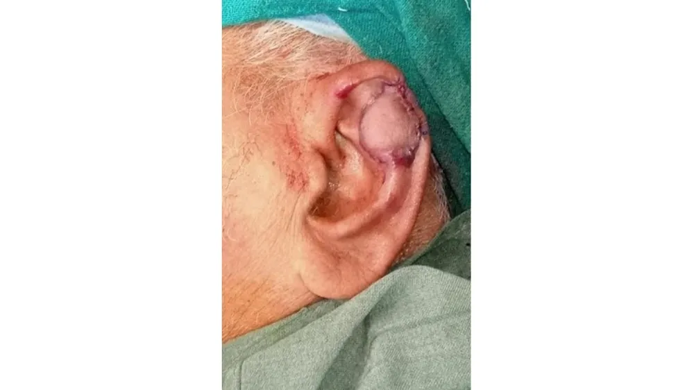 After surgery